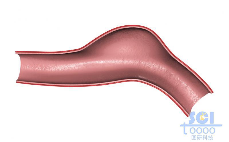 帶腫瘤結(jié)構(gòu)的半剖面的血管示意圖